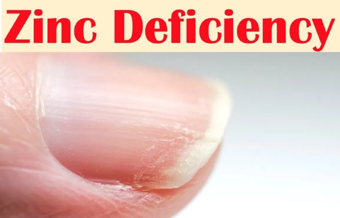 Zinc Deficiency