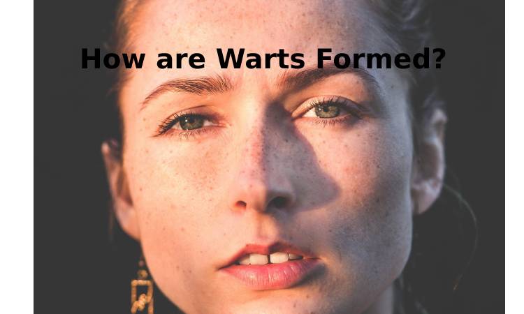 How are Warts Formed_